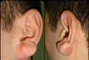 Kulak Kanseri Belirtileri ve Tedavisi