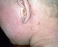 Kulak Egzaması Belirtileri ve Tedavisi