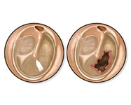 Kulak Zarı Delinmesi