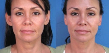 Kepçe Kulak Estetiği